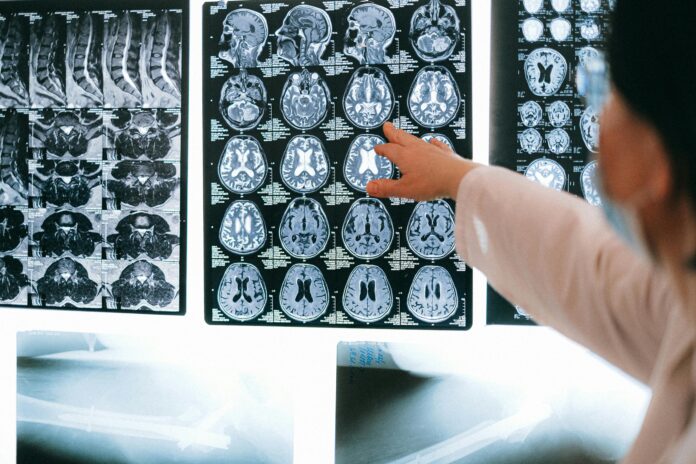 Photo by Anna Shvets/Pexels Stock photograph of brain MRI results